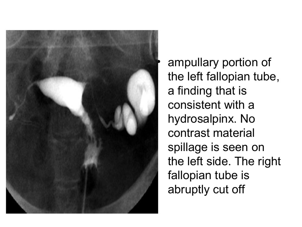 Hysterosalpingography cases