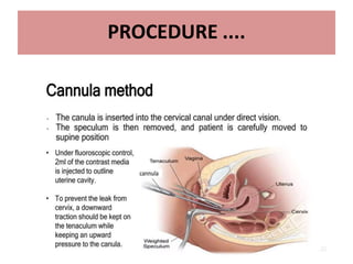 13
PROCEDURE ....
• Tenaculm is used to hold anterior lip of cervix .
• Speculum is removed & Patient is placed in slight
trendelenburg position and contrast is slowly given
• 3 ml contrast to fill uterine cavity and another 3 ml to
fill tube. ( up to 10 ml)
• 4 spot films are taken
• Additional oblique views may be taken for optimal
visualisation of pelvic pathology and tortuous fallopian
tubes( to see retroverted or anteverted)
• After end of the procedure , antibiotic course is given
and patient is informed about vaginal spotting for 1-2
days
 