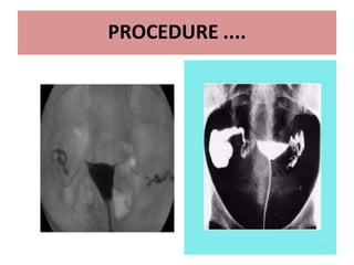 17
PROCEDURE ....
• Tenaculm is used to hold anterior lip of cervix .
• Speculum is removed & Patient is placed in slight
trendelenburg position and contrast is slowly given
• 3 ml contrast to fill uterine cavity and another 3 ml to
fill tube. ( up to 10 ml)
• 4 spot films are taken
• Additional oblique views may be taken for optimal
visualisation of pelvic pathology and tortuous fallopian
tubes( to see retroverted or anteverted)
• After end of the procedure , antibiotic course is given
and patient is informed about vaginal spotting for 1-2
days
 