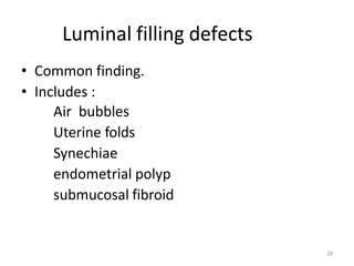 28
Luminal filling defects
• Common finding.
• Includes :
Air bubbles
Uterine folds
Synechiae
endometrial polyp
submucosal fibroid
 