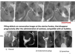 Filling defects on consecutive images at the uterine fundus, that disappear
progressively after the administration of contrast, compatible with air bubbles.
30
DISAPPEARS
DDs
1) Fibroid
2) Endometrial polyp 3) Synechiae
 
