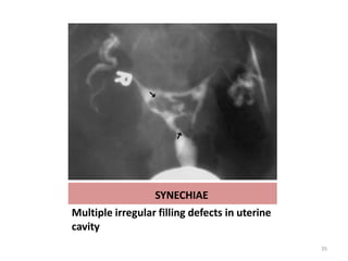 SYNECHIAE
Multiple irregular filling defects in uterine
cavity
35
 
