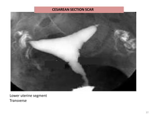 Lower uterine segment
Transverse
37
CESAREAN SECTION SCAR
 
