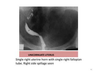 UNICORNUATE UTERUS
Single right uterine horn with single right fallopian
tube. Right side spillage seen
41
 