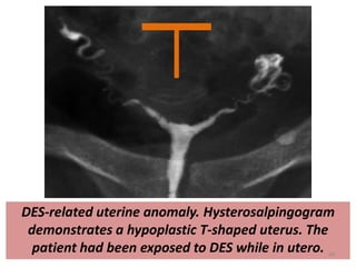 DES-related uterine anomaly. Hysterosalpingogram
demonstrates a hypoplastic T-shaped uterus. The
patient had been exposed to DES while in utero. 48
 