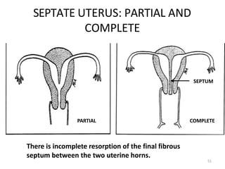 SEPTATE UTERUS: PARTIAL AND
COMPLETE
There is incomplete resorption of the final fibrous
septum between the two uterine horns.
51
SEPTUM
PARTIAL COMPLETE
 