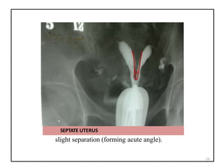 slight separation (forming acute angle).
SEPTATE UTERUS
53
 