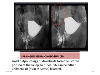 SALPINGITIS ISTHMIC NODOSUM (SIN)
small outpouchings or diverticula from the isthmic
portion of the fallopian tubes. SIN can be either
unilateral or (as in this case) bilateral.
3-Jan-16 53
55
 