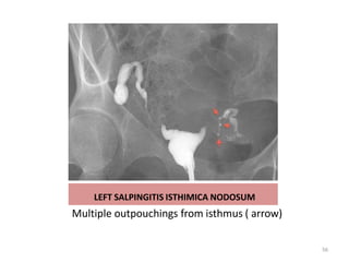 LEFT SALPINGITIS ISTHIMICA NODOSUM
Multiple outpouchings from isthmus ( arrow)
56
 