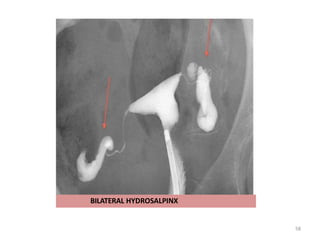 BILATERAL HYDROSALPINX
58
 