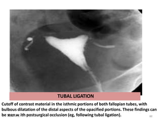 Cutoff of contrast material in the isthmic portions of both fallopian tubes, with
bulbous dilatation of the distal aspects of the opacified portions. These findings can
be se3
-
eJ
a
nn
-
1
w6 ith postsurgical occlusion (eg, following tubal ligation).
TUBAL LIGATION
60
60
 