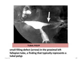 TUBAL POLYP
small filling defect (arrow) in the proximal left
fallopian tube, a finding that typically represents a
tubal polyp
3-Jan-16 57
61
 
