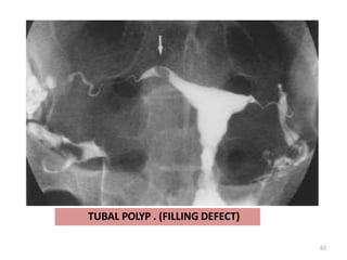TUBAL POLYP . (FILLING DEFECT)
62
 