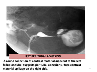 LEFT PERITUBAL ADHESION
A round collection of contrast material adjacent to the left
fallopian tube, suggests peritubal adhesions. Ja
f
nr
-1
e
6 e contrast
material spillage on the right side. 61
63
 