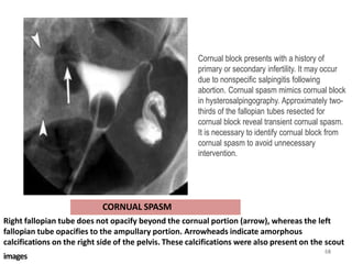 Right fallopian tube does not opacify beyond the cornual portion (arrow), whereas the left
fallopian tube opacifies to the ampullary portion. Arrowheads indicate amorphous
calcifications on the right side of the pelvis. These calcifications were also present on the scout
CORNUAL SPASM
images
65
64
Cornual block presents with a history of
primary or secondary infertility. It may occur
due to nonspecific salpingitis following
abortion. Cornual spasm mimics cornual block
in hysterosalpingography. Approximately two-
thirds of the fallopian tubes resected for
cornual block reveal transient cornual spasm.
It is necessary to identify cornual block from
cornual spasm to avoid unnecessary
intervention.
 