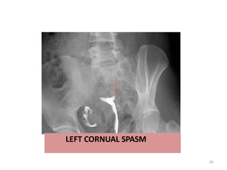 LEFT CORNUAL SPASM
65
 