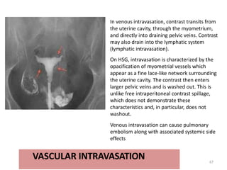 VASCULAR INTRAVASATION 67
In venous intravasation, contrast transits from
the uterine cavity, through the myometrium,
and directly into draining pelvic veins. Contrast
may also drain into the lymphatic system
(lymphatic intravasation).
On HSG, intravasation is characterized by the
opacification of myometrial vessels which
appear as a fine lace-like network surrounding
the uterine cavity. The contrast then enters
larger pelvic veins and is washed out. This is
unlike free intraperitoneal contrast spillage,
which does not demonstrate these
characteristics and, in particular, does not
washout.
Venous intravasation can cause pulmonary
embolism along with associated systemic side
effects
 