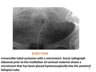 SCOUT FILM
Irreversible tubal occlusion with a microinsert. Scout radiograph
obtained prior to the instillation of contrast material shows a
microinsert that has been placed hysteroscopically into the proximal
69
fallopian tube.
68
 