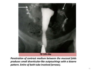 TB SIN-like
Penetration of contrast medium between the mucosal folds
produces small diverticular-like outpouchings with a bizarre
pattern. Entire of both tube involved (arrows).
72
 