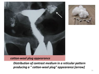 cotton-wool plug appearance
Distribution of contrast medium in a reticular pattern
producing a " cotton-wool plug" appearance [arrow]
73
 