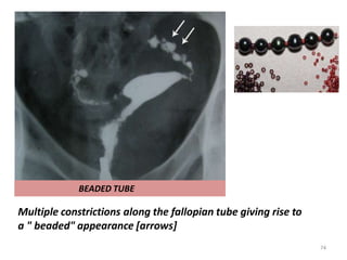 BEADED TUBE
Multiple constrictions along the fallopian tube giving rise to
a " beaded" appearance [arrows]
74
 