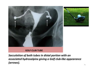 GOLF CLUB TUBE
Sacculation of both tubes in distal portion with an
associated hydrosalpinx giving a Golf club-like appearance
(arrows).
75
 