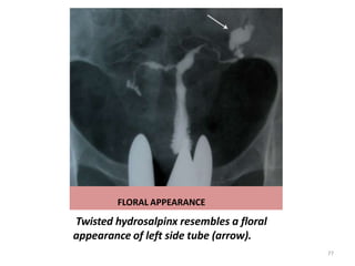 FLORAL APPEARANCE
Twisted hydrosalpinx resembles a floral
appearance of left side tube (arrow).
77
 