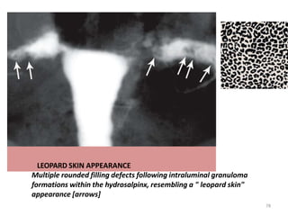 LEOPARD SKIN APPEARANCE
Multiple rounded filling defects following intraluminal granuloma
formations within the hydrosalpinx, resembling a " leopard skin"
appearance [arrows]
78
 