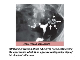 COBBLE STONE APPEARANCE
Intraluminal scarring of the tube gives rises a cobblestone
like appearance which is an effective radiographic sign of
intraluminal adhesions
79
 