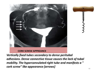 CORK SCREW APPREANCE
Vertically fixed tubes secondary to dense peritubal
adhesions. Dense connective tissue causes the lack of tubal
mobility. The hyperconvulated right tube and manifests a "
cork screw" like appearance [arrows] 80
 