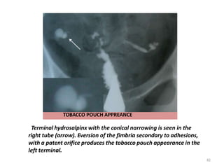TOBACCO POUCH APPREANCE
Terminal hydrosalpinx with the conical narrowing is seen in the
right tube (arrow). Eversion of the fimbria secondary to adhesions,
with a patent orifice produces the tobacco pouch appearance in the
left terminal.
82
 