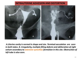 A.Uterine cavity is normal in shape and size. Terminal sacculation are seen
in both tubes. B. Irregularity, multiple filling defects and obliteration of right
ostium secondary to extensive synechiae formation in this site. Obstruction of
left tube is also seen.
83
A B
INTRAUTERINE ADHESION AND DISTORTION
 