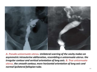 A. Pseudo-unicornuate uterus. Unilateral scarring of the cavity makes an
asymmetric intrauterine obliteration, resembling a unicornuate uterus. the
irregular contour and vertical orientation of long axis. B. True unicornuate
uterus. the smooth contour, more horizontal orientation of long axis and
normal ipsilateral fallopian tube.
84
 