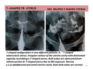 T –SHAPED TB UTERUS DES RELATED T SHAPED UTERUS
T-shaped configuration in two different patients. A. " T-shaped"
tuberculosis uterus. Irregular contour of the uterine cavity with diminished
capacity resembling a T-shaped uterus. Both tubes are obstructed from
isthmic portion.B. T-shaped uterus due to DES exposure. Narrow
3e-Jann-d16ocervicalcanal and small uterine cavity. Note both tubes are normal. 86
85
 