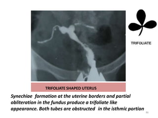 TRIFOLIATE SHAPED UTERUS
Synechiae formation at the uterine borders and partial
obliteration in the fundus produce a trifoliate like
appearance. Both tubes are obstructed in the isthmic portion
86
 