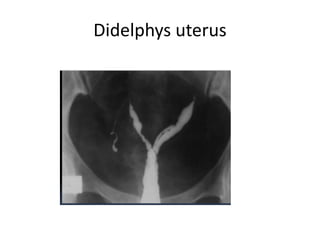 Didelphys uterus
 