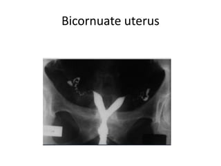 Bicornuate uterus
 