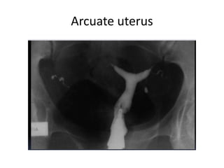 Arcuate uterus
 