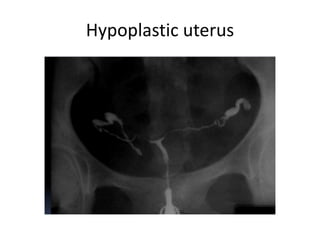 Hypoplastic uterus
 