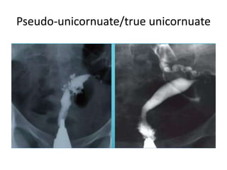 Pseudo-unicornuate/true unicornuate
 