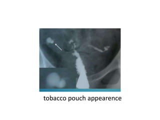 tobacco pouch appearence
 