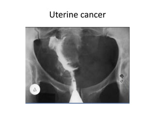 Uterine cancer
 