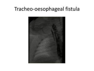 Tracheo-oesophageal fistula
 