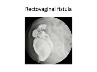 Rectovaginal fistula
 