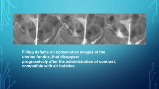 Filling defects on consecutive images at the
uterine fundus, that disappear
progressively after the administration of contrast,
compatible with air bubbles
 