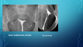 RIGHT SUBMUCOSAL MYOMA Synechiae
 