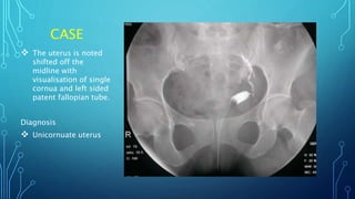CASE
 The uterus is noted
shifted off the
midline with
visualisation of single
cornua and left sided
patent fallopian tube.
Diagnosis
 Unicornuate uterus
 