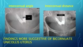 FINDINGS MORE SUGGESTIVE OF BICORNUATE
UNICOLLIS UTERUS
Intercornual angle Intercornual distance
41mm
110°
 