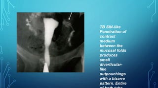 TB SIN-like
Penetration of
contrast
medium
between the
mucosal folds
produces
small
diverticular-
like
outpouchings
with a bizarre
pattern. Entire
 