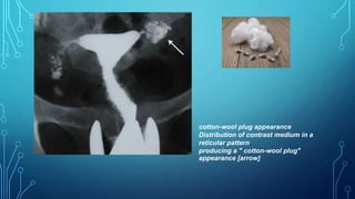 cotton-wool plug appearance
Distribution of contrast medium in a
reticular pattern
producing a " cotton-wool plug"
appearance [arrow]
 
